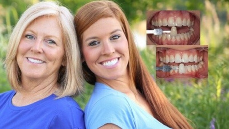 Up to 50% Off on Teeth Whitening - In-Office - Branded (Zoom, Brite Smile) at The Whitening Shop