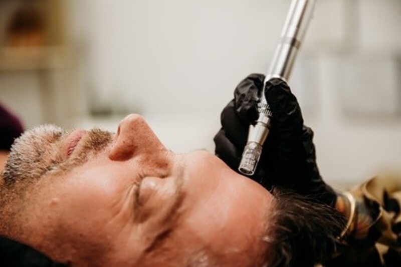 Up to 50% Off on Micro-Needling at True Nature Skin+Energy MedSpa