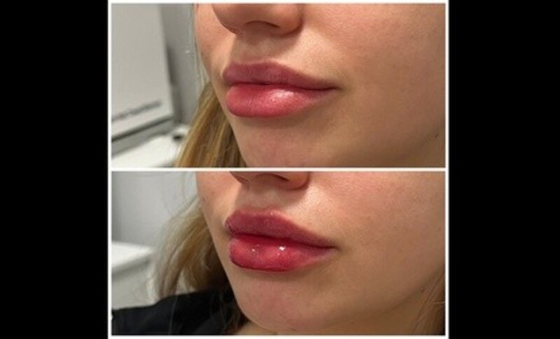 Up to 44% Off on Lip Enhancement at Ethereal Esthetics