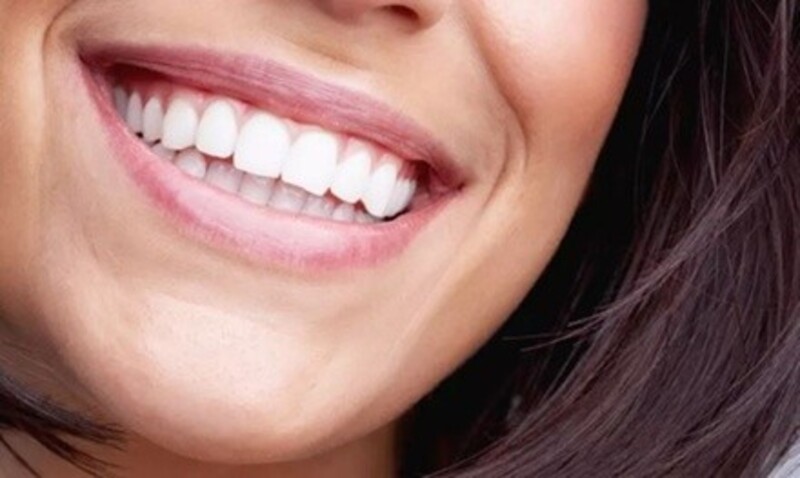 Up to 61% Off on Teeth Whitening - In-Office - Non-Branded at Tempe Laser Center